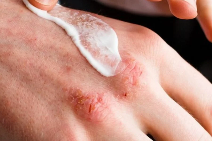  Eczema Creams | Trendingcult